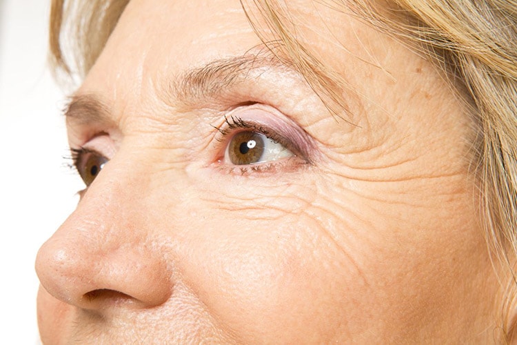 Lines And Wrinkles Removal